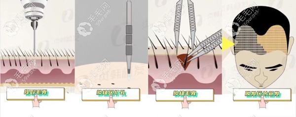 植发手术流程展示