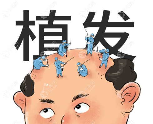发际线种植头发5年后真实感受