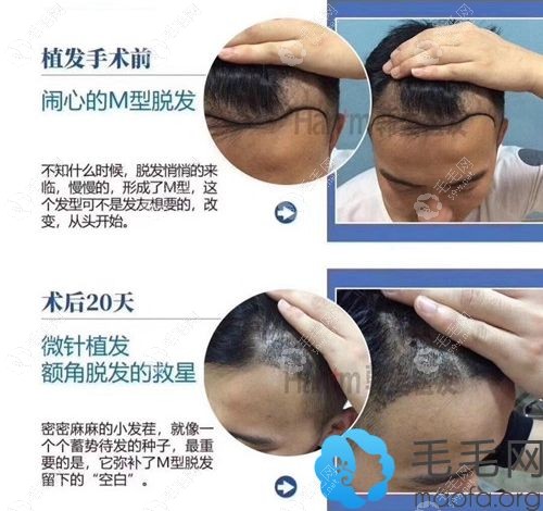 M型发际线种植案例效果