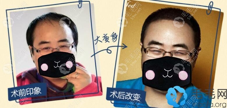 男士在武汉碧莲盛植发<span style=