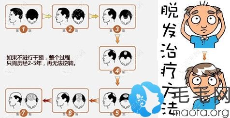脫發(fā)種度的劃分及相應(yīng)的治療方法