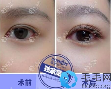 武汉瑞丽诗植发正规吗？睫毛种植<span style=