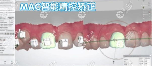 广州家庭医生口腔年底正畸优惠5800元起