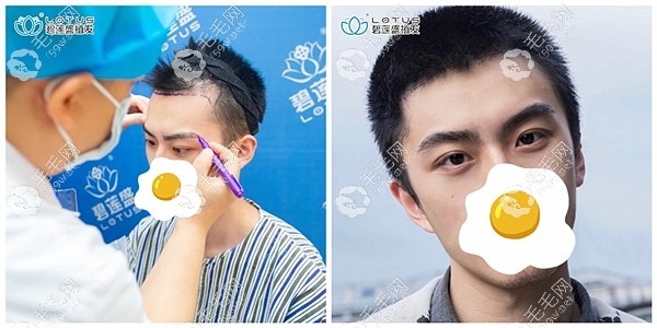 蘭州碧蓮盛?？浦舶l(fā)醫(yī)院男生眉毛+額角植發(fā)效果案例圖