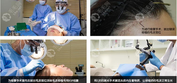 女性發(fā)際線手術(shù)失敗后再修復(fù)手術(shù)前