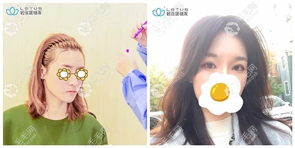 蘭州碧蓮盛植發(fā)醫(yī)院女生發(fā)際線植發(fā)效果、可靠嗎？