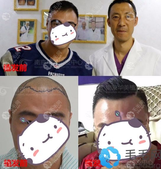 南京华美刘学新发际线种植+头顶加密种植案例