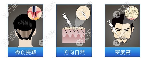 种胡须手术过程示意图