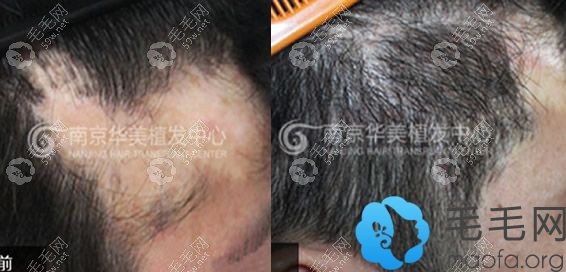南京华美刘学习疤痕植发前后对比照片