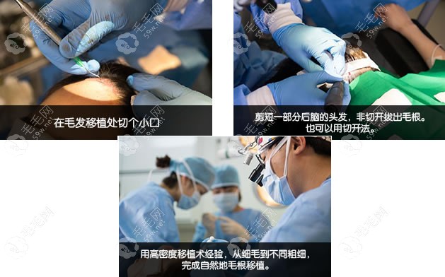 女性發(fā)際線手術(shù)失敗后再修復(fù)手術(shù)中
