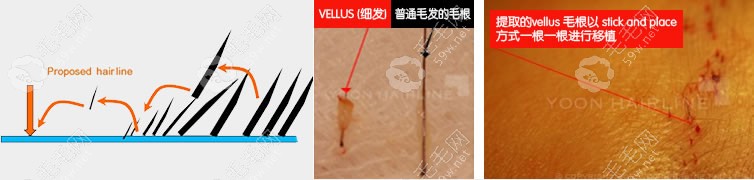 VELLUS毛發(fā)移植術(shù)原理
