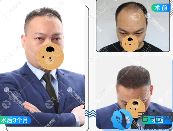 廣州曙光整形美容醫(yī)院植發(fā)案例效果展示