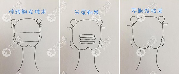 剃发植发、分层不剃发植发、不剃发植发示意图