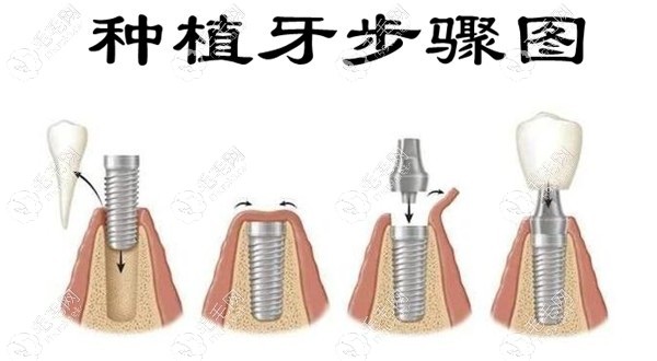 即刻种植和普通延期3个月后种植牙的区别有哪些