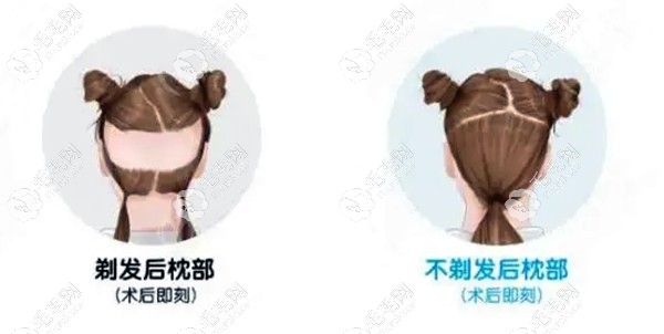 剃發(fā)后枕部和不剃發(fā)后枕部對比圖