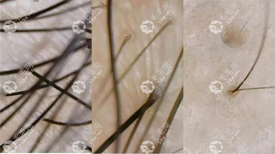 眉毛種植區(qū)的生長特性是什么毛毛網(wǎng)