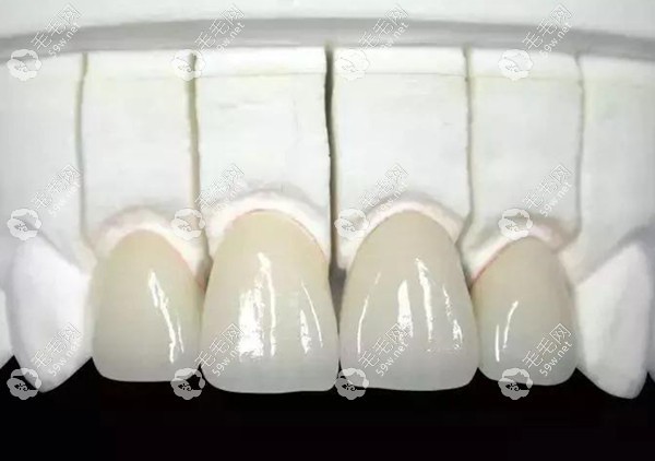 氧化鋯全瓷牙冠