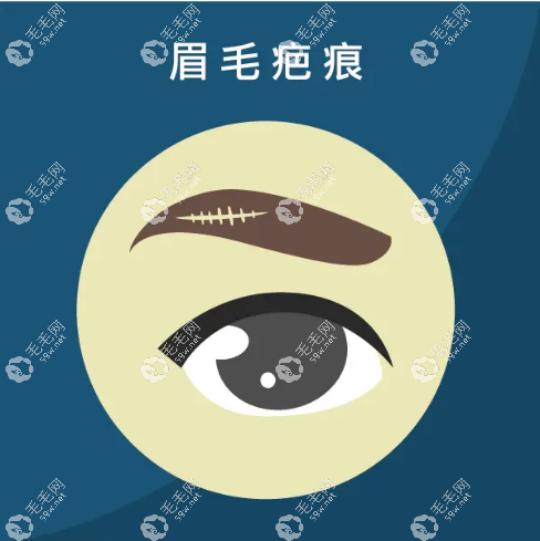 眉毛種植會長的像頭發(fā)一樣長么