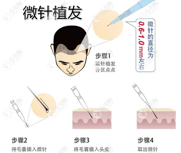 青島微針植發(fā)技術(shù)