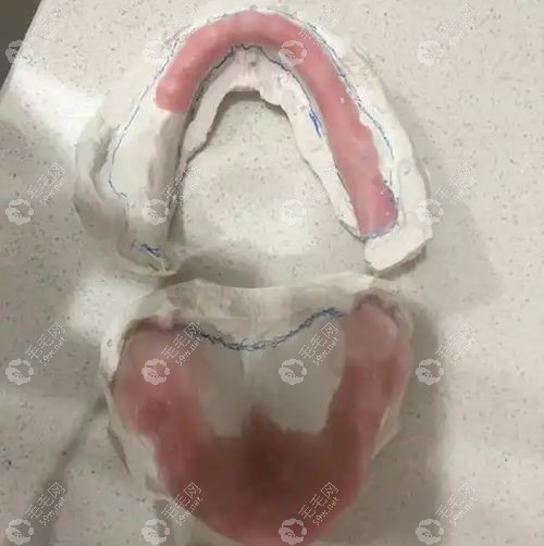 吸附性义齿多少钱一口？5k起，全口吸附性义齿比种植牙省2w+