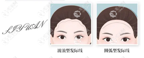 发际线植发欢迎咨询