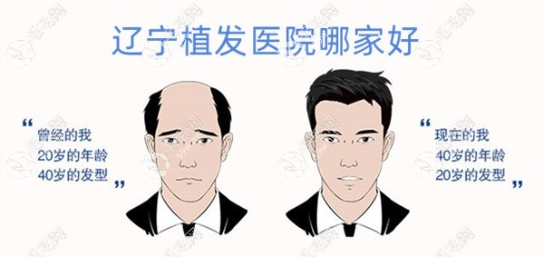 遼寧植發(fā)醫(yī)院哪家好