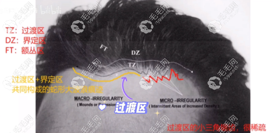 宁波碧莲盛是发际线调整的实力医院