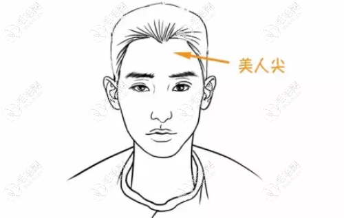 男士美人尖種植費用