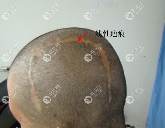線性疤痕示例圖