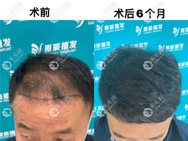 温州原辰头顶加密植发效果