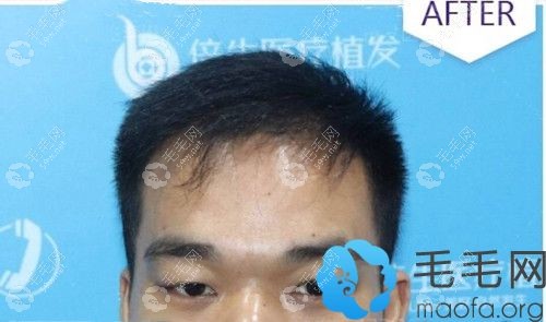 頭頂加密術(shù)后8個月效果