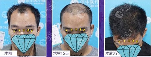 1-8個頭頂加密植發(fā)效果圖