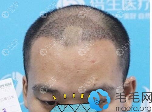 在頭頂做了SEP精細微針種植