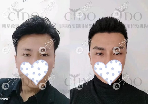 西安熙朵男士植眉毛效果图