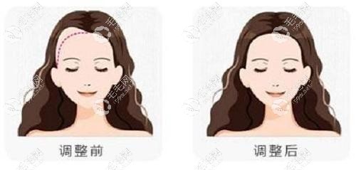 發(fā)際線調(diào)整前后對比