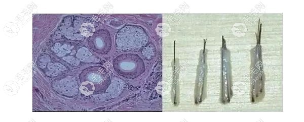 后枕部提取完毛囊地方还长头发吗?
