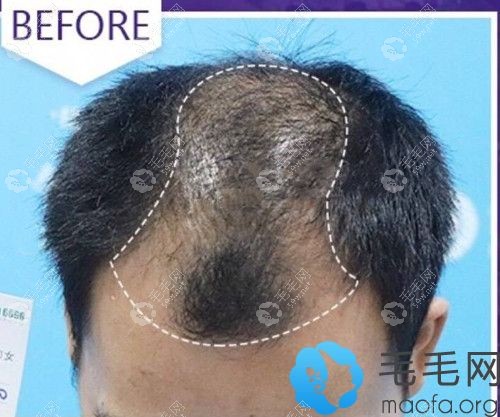 頭頂頭發(fā)稀疏、頭皮隱約可見