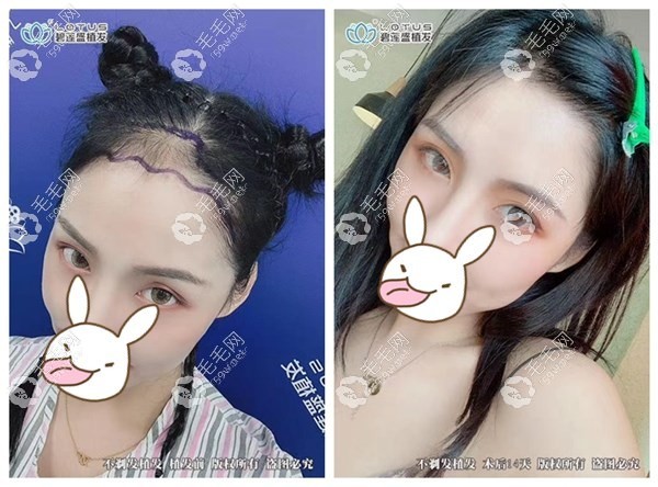 碧莲盛NHT不剃发植发
