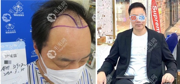 AFHT男士植發(fā)效果圖