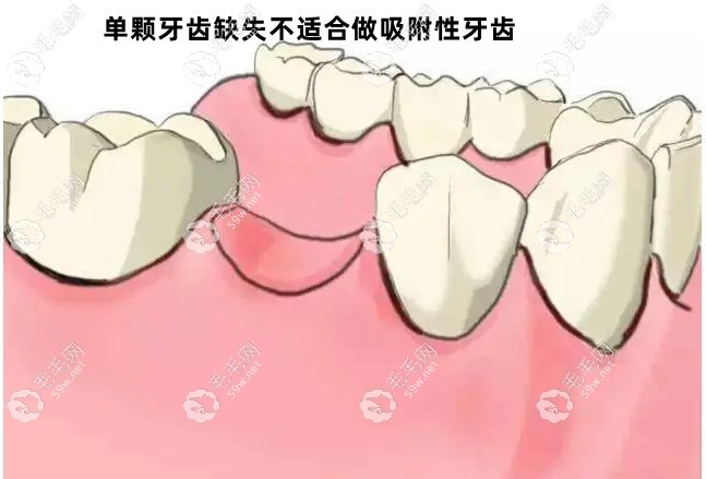 吸附性义齿不适应人群