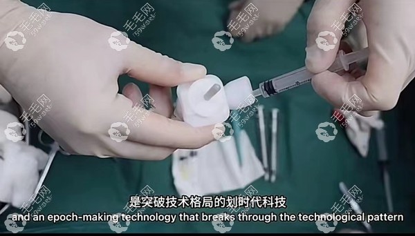 微芮希微移植多少錢