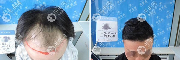 SHT技術(shù)植發(fā)5500毛囊單位一年前后對(duì)比圖