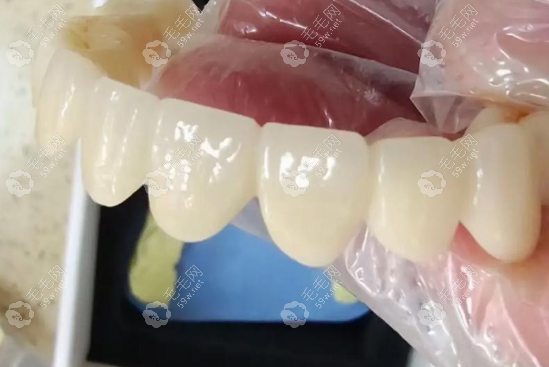 德国西诺德全瓷牙
