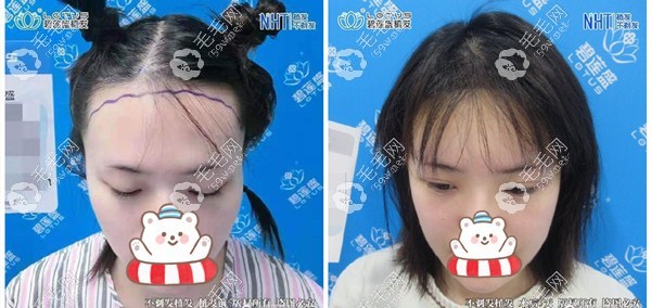 NHT不剃發(fā)植發(fā)際線5天效果