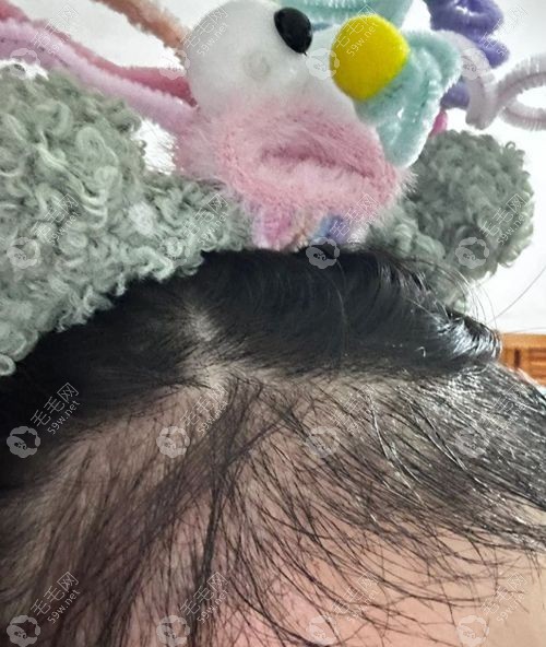 发际线种植5年后真实感受:1500单位实拍图,术后5年成效公开