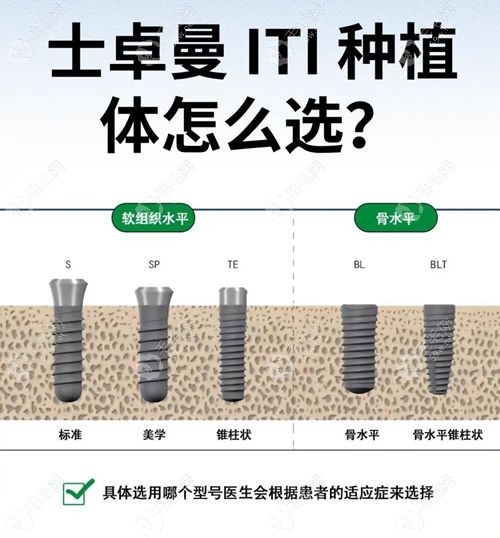 士卓曼iti和瑞士iti是一样的,详解士卓曼iti优缺点|型号|价格