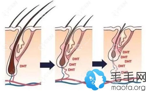 非那雄胺的治脱原理