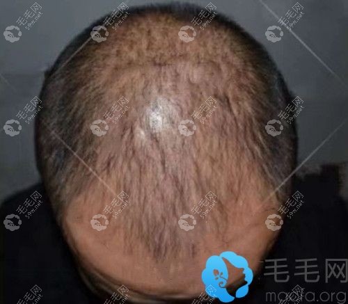 我服用非那雄胺片三年后的效果