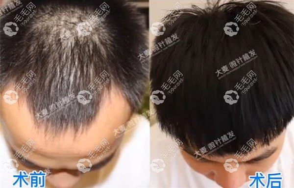 大麥微針發(fā)際線種植效果