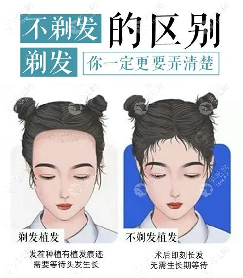 不剃发植发际线